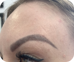 Brow lift after