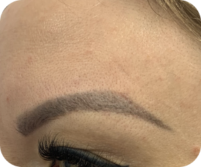 Brow lift before