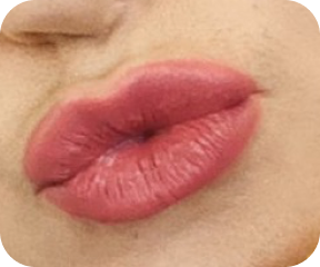 Lip fillers after