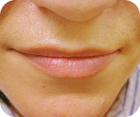 Lip fillers before