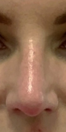 Non surgical Rhinoplasty After