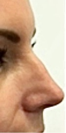 Non surgical Rhinoplasty Before