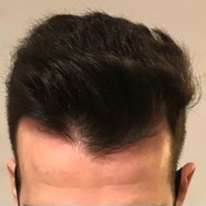 Hairloss-Treatment-After-2