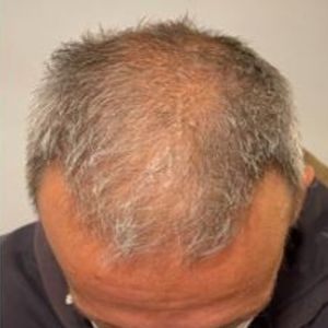 Hairloss-Treatment-Before