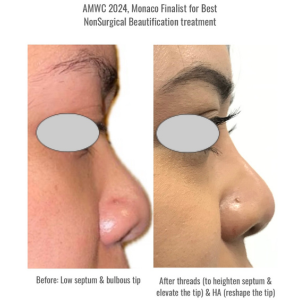 MINT PDO Non-surgical Rhinoplasty