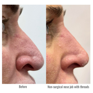 MINT PDO Non-surgical Rhinoplasty